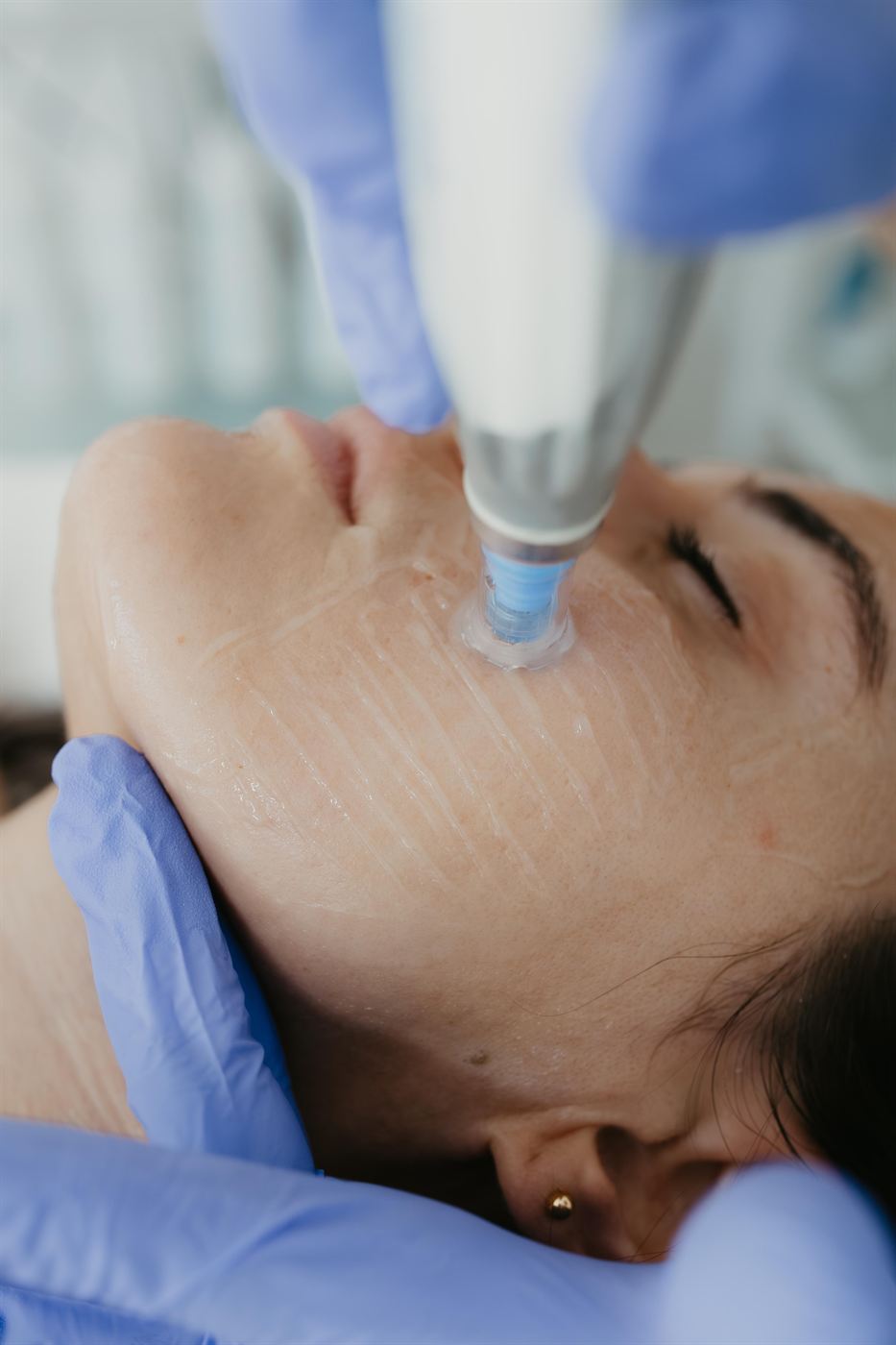 Dermapen 4 - Microneedling